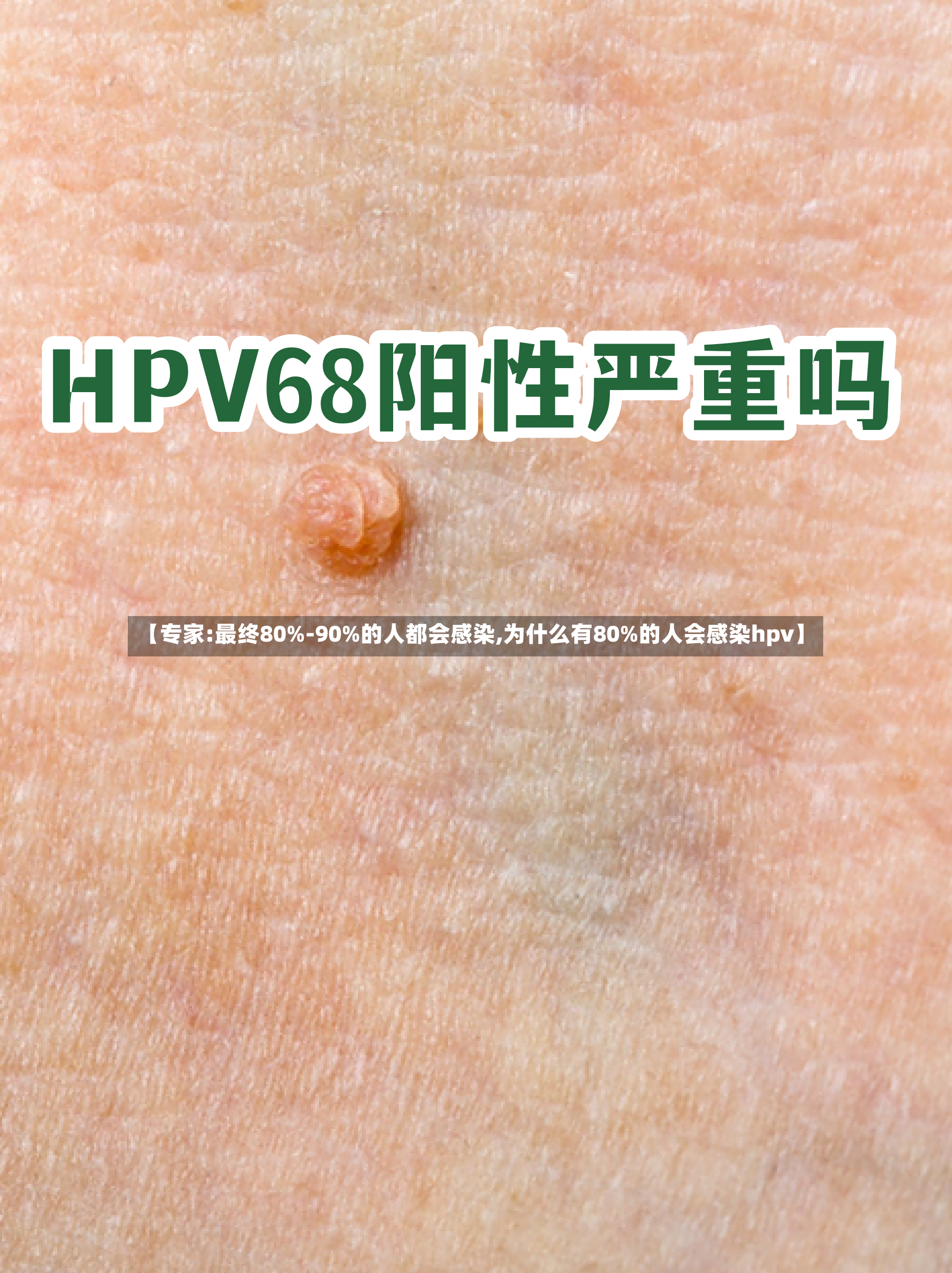 【专家:最终80%-90%的人都会感染,为什么有80%的人会感染hpv】