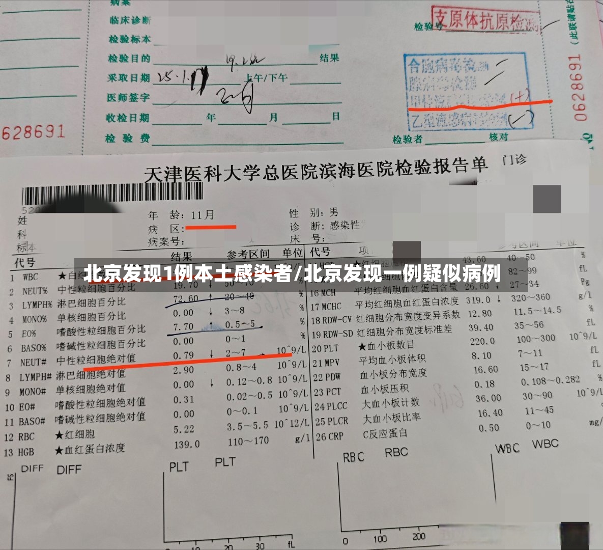 北京发现1例本土感染者/北京发现一例疑似病例